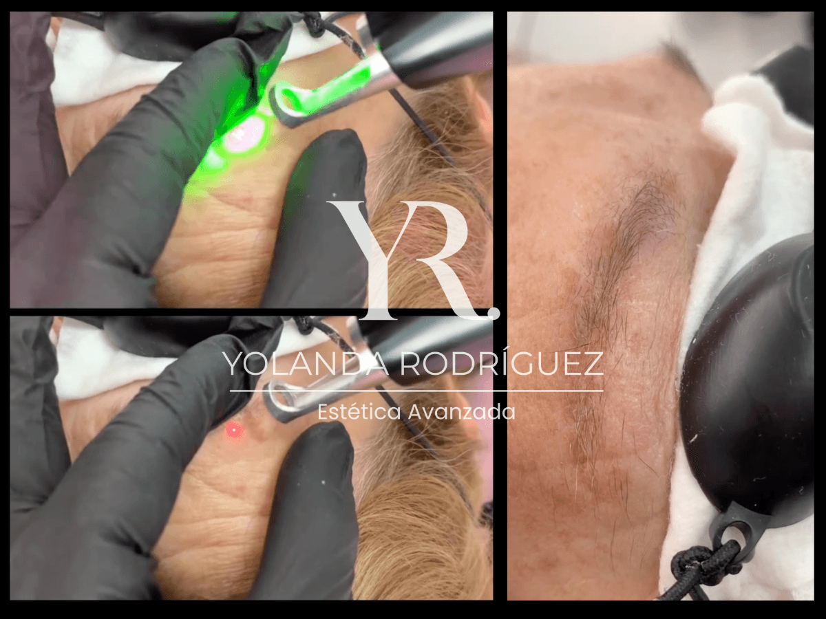 Borrado de Micropigmentación - Yolanda Rodríguez